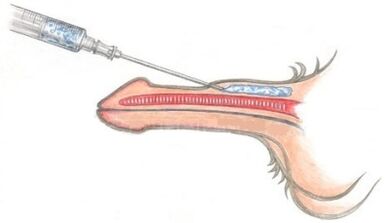 Das Einbringen von Polymermaterialien in den Penis, um ihn zu verdicken