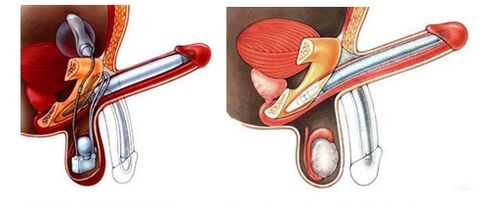 Penisprothese mit aufblasbarer Prothese (links) und Kunststoff (rechts)