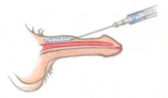 Volumengebende Hyaluronsäure-Injektion in den Penis